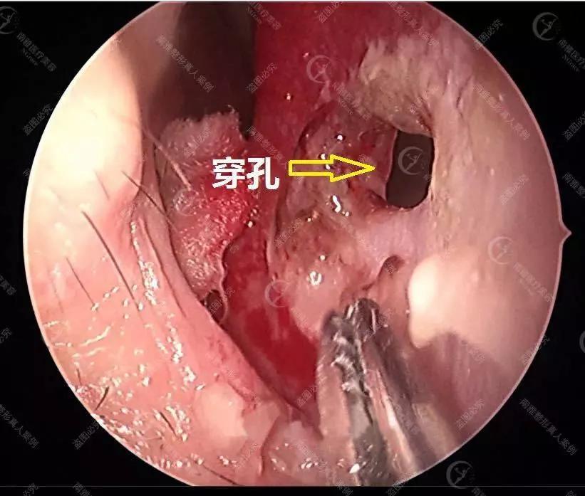 术前,小帅哥鼻中隔因为上次隆鼻受到严重损坏,医生打开鼻腔已经被破烂