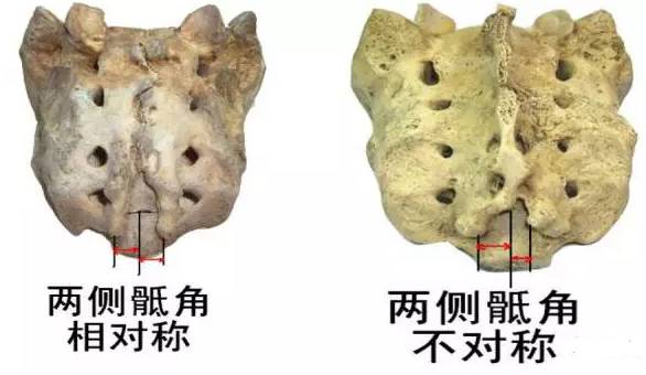 骶骨常见的解剖变异图文并茂