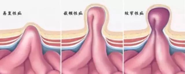                     心痛！2岁幼女竟卵巢坏死，只因宝妈忽视了一个“小包块”...