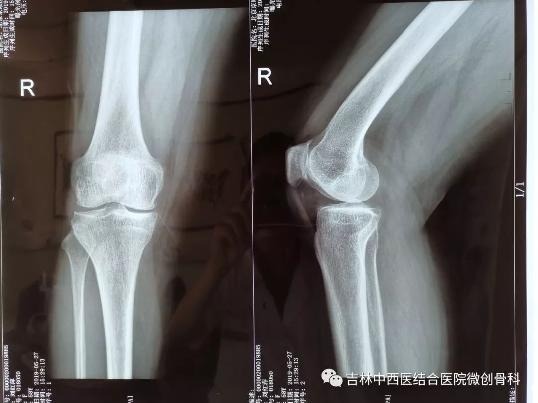 术前患者的病情均较长,近来出现膝关节疼痛肿胀难忍,尤以内侧疼痛
