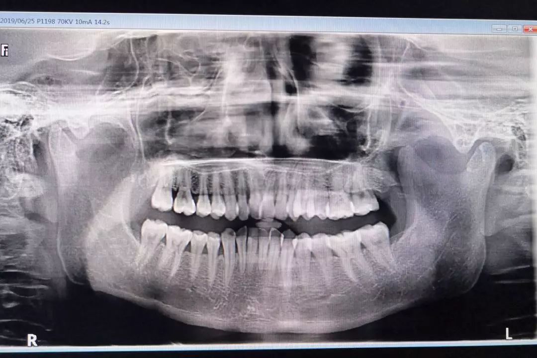 胶片冲洗,操作时需将牙片放到口腔内,每次只能完成两三颗牙齿的摄片