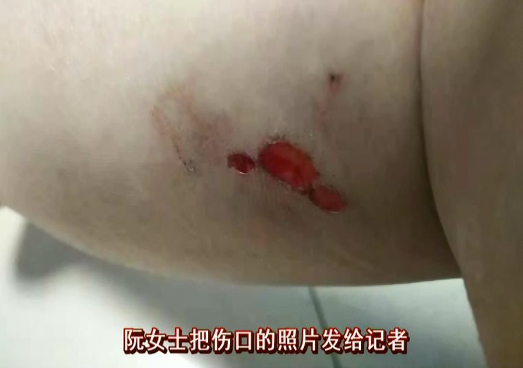台州一女子去买菜,被狗咬成这样.看着就痛心!