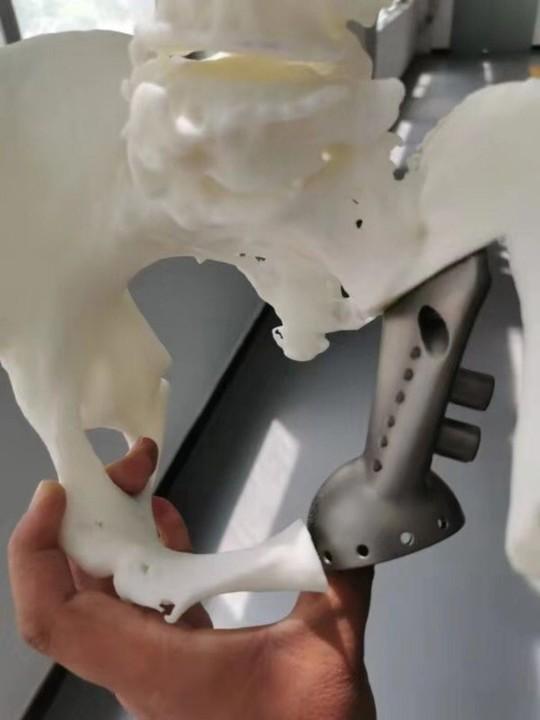 手术时间减短至6个多小时四川省人民医院完成西南首例3d打印半骨盆