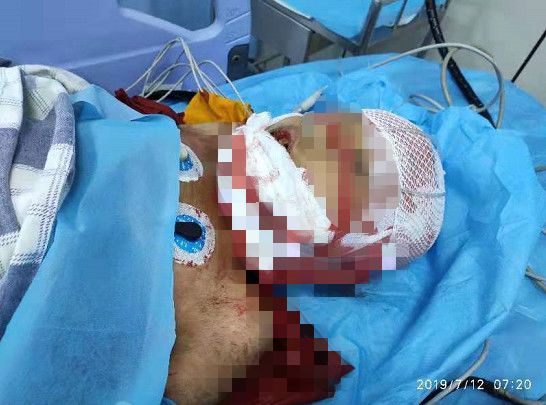                     因这个动作，南宁8岁小男孩面部严重撕裂，暑假安全不容忽视...【930新闻眼】