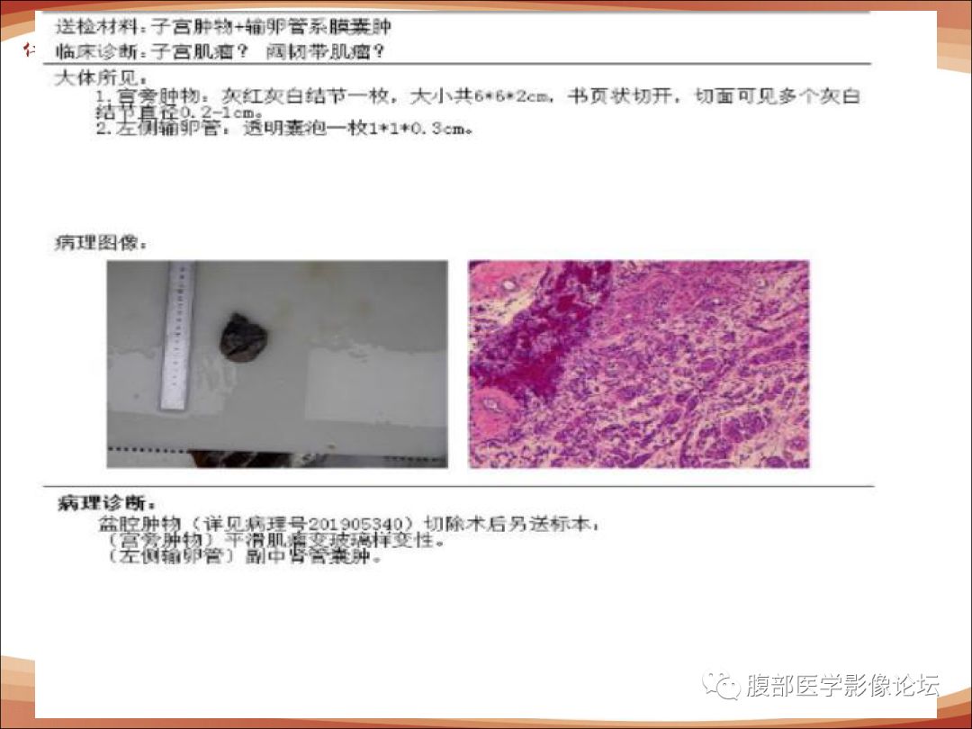 宫颈肿物平滑肌瘤伴玻璃样变扫描文末二维码查看完整群内聊天