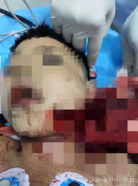                     因这个动作，南宁8岁小男孩面部严重撕裂，暑假安全不容忽视...【930新闻眼】