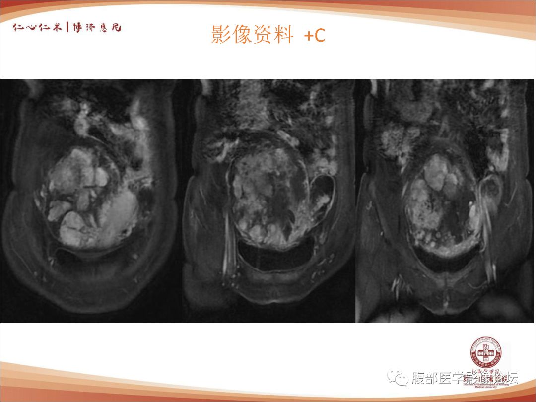 什么是子宫平滑肌肌瘤 d0760fede1eb4962a32489e7bcd6dd80.jpeg