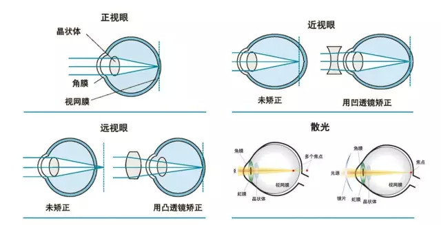 (真,假近视,高度近视)三,青少年—屈光不正措施:建议2-3岁时做一次