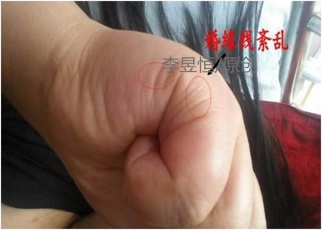 手相实例女人小指外撇谨防婚姻亮红灯