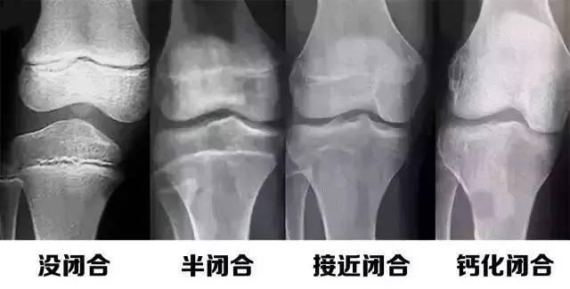                     9岁女孩身高停止在150，骨科医生：全都是宝妈的“好习惯”害了娃