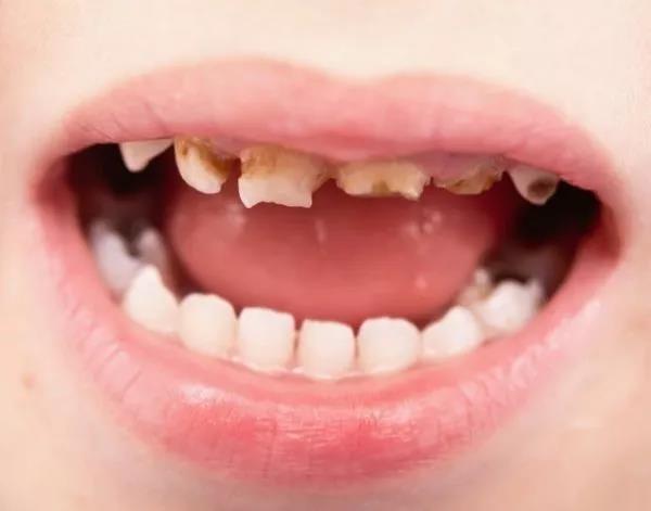 儿童龋齿逐年上升,比刷牙更重要的是这2件事!