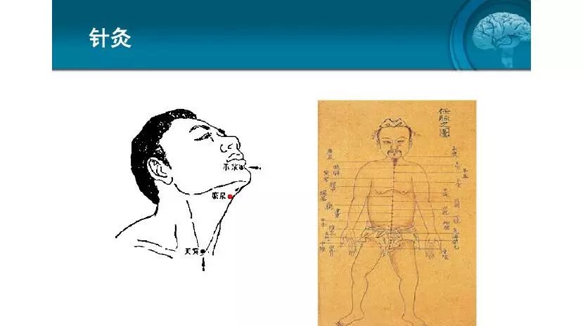 脑卒中后吞咽功能障碍的康复与护理