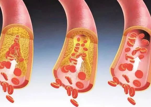 血管"堵塞"的人,往往有6个共性,若一个不占,你的血管很年轻