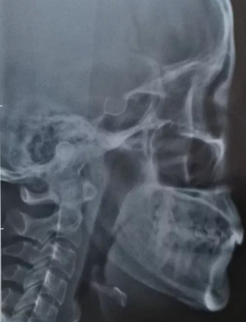 四千块割的双眼皮,再花四万缝回来 | 整形花过的