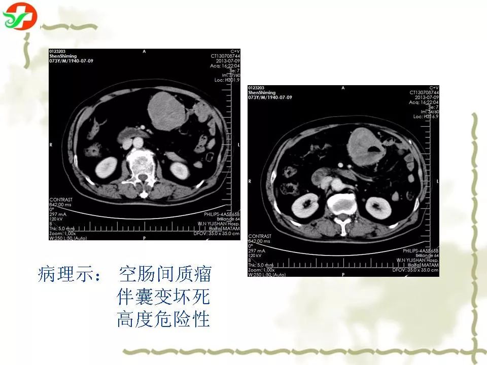 胃肠道间质瘤ct,mri诊断 | 影像天地