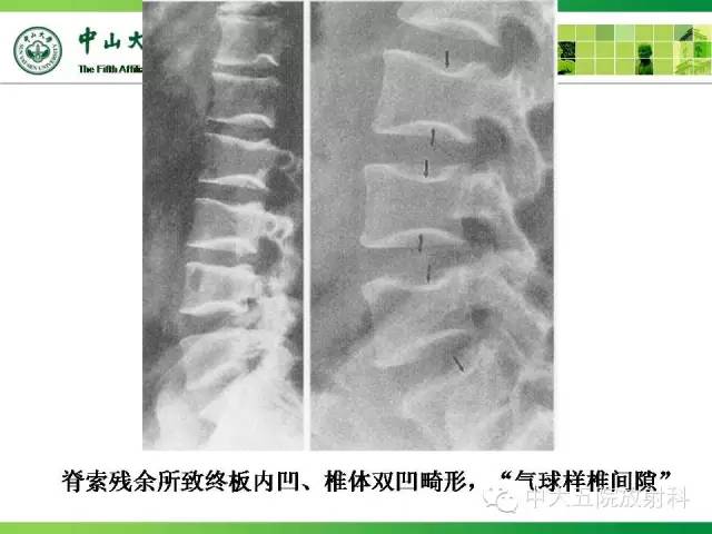 骨关节影像常见解剖变异