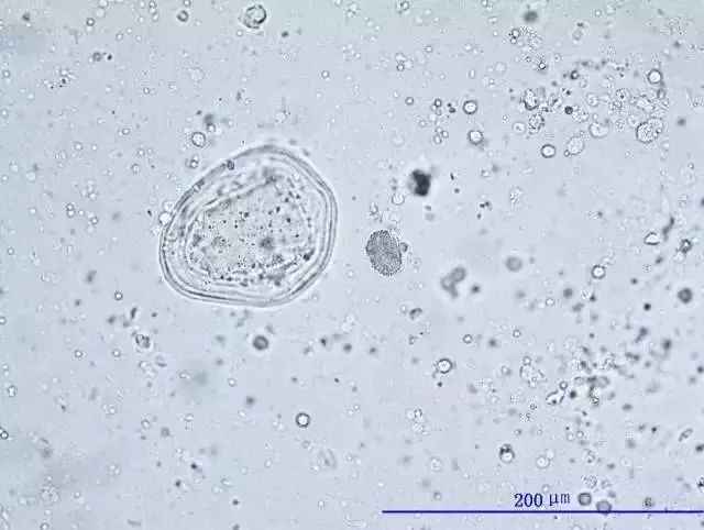 前列腺液细胞形态学特征与临床意义