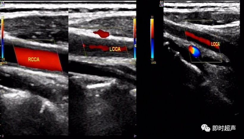 超声所见:无名动脉,双侧颈总动脉,锁骨下动脉管壁均不同程度增厚(左侧