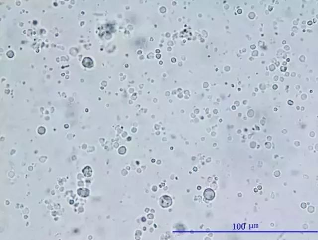 前列腺液细胞形态学特征与临床意义