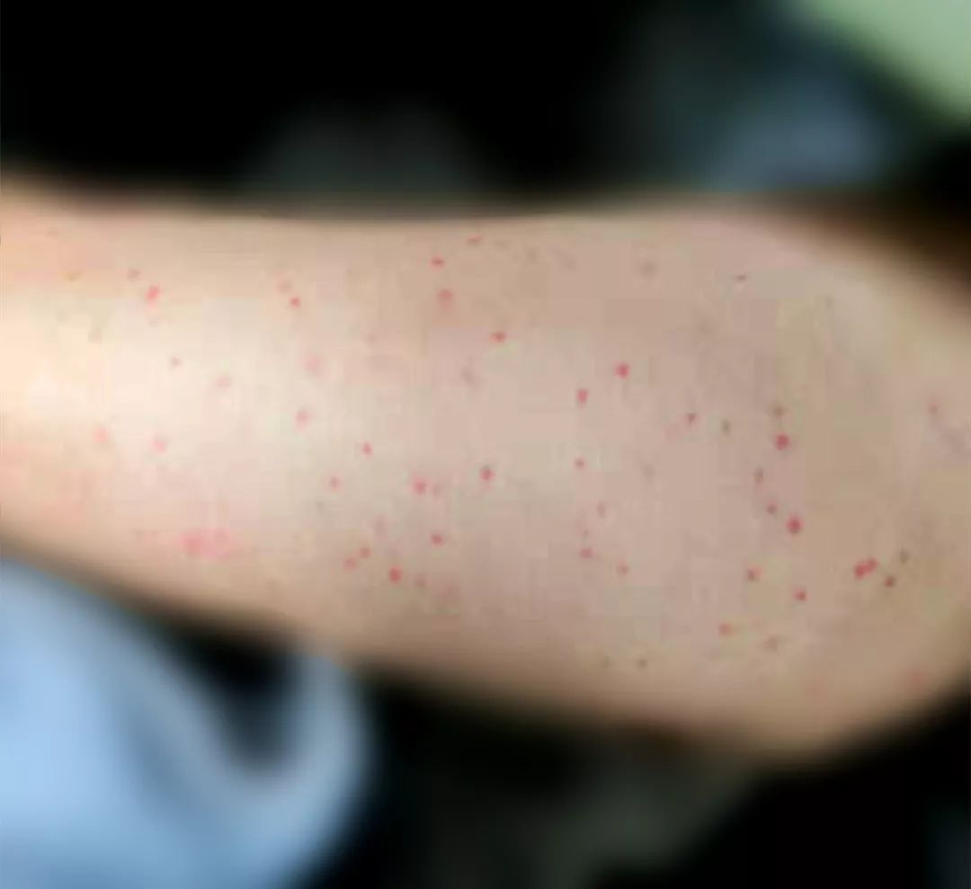 呆!了! 一双美腿,黑点,红点一大片 这个小红点还奇痒无比!