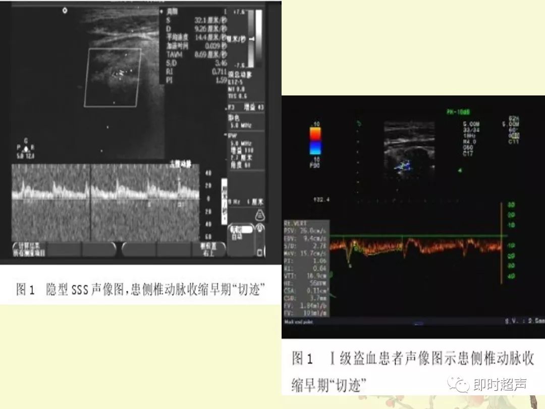 多发性大动脉炎的超声诊断与鉴别