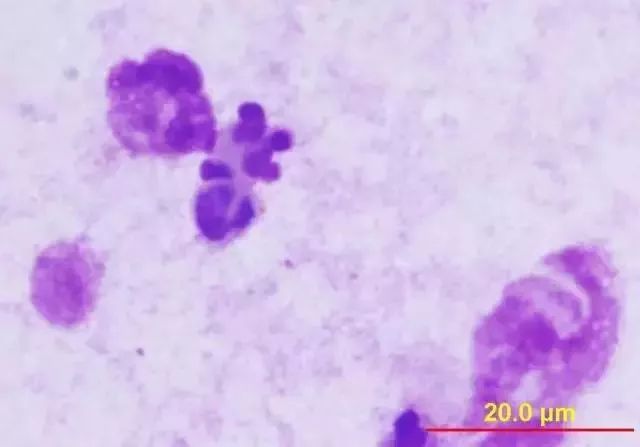 前列腺液细胞形态学特征与临床意义