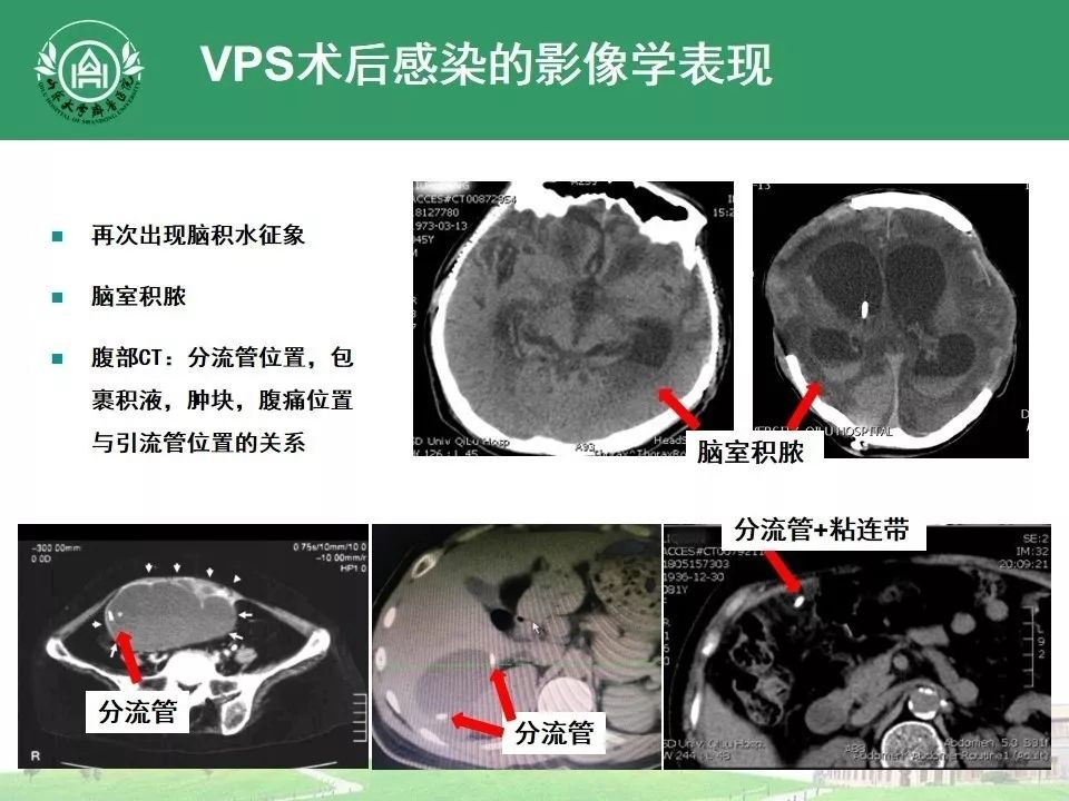 脑积水腹腔分流术后感染的治疗经验分享 | 颅脑创伤-神经重症病例周刊