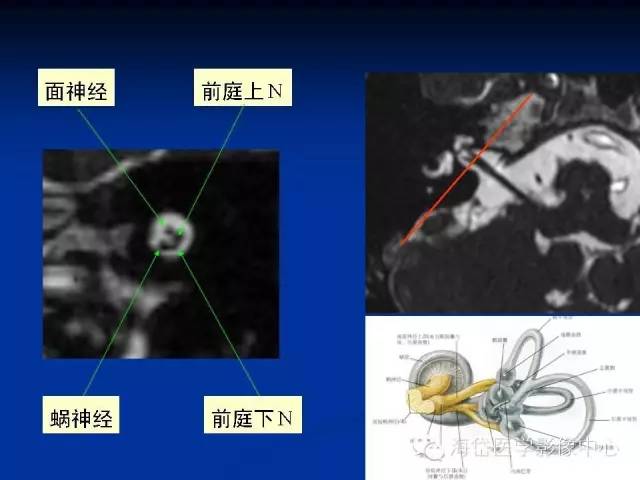 耳部ct及mri解剖