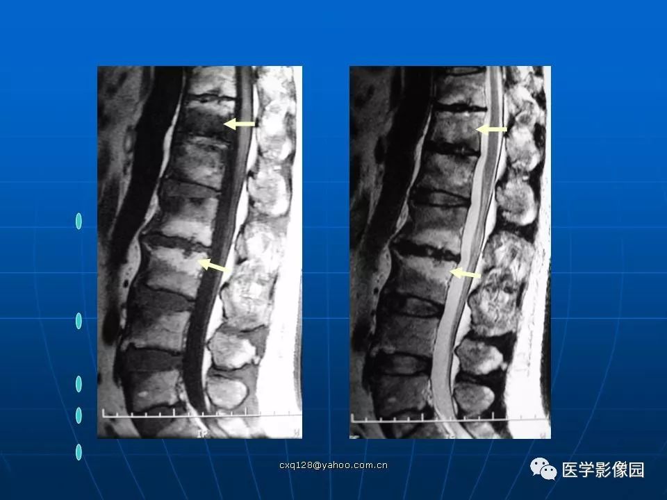 椎体终板骨软骨炎的影像学表现