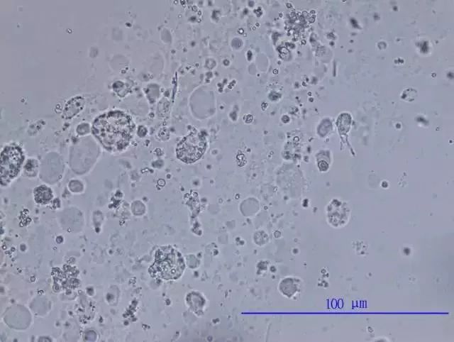 前列腺液细胞形态学特征与临床意义