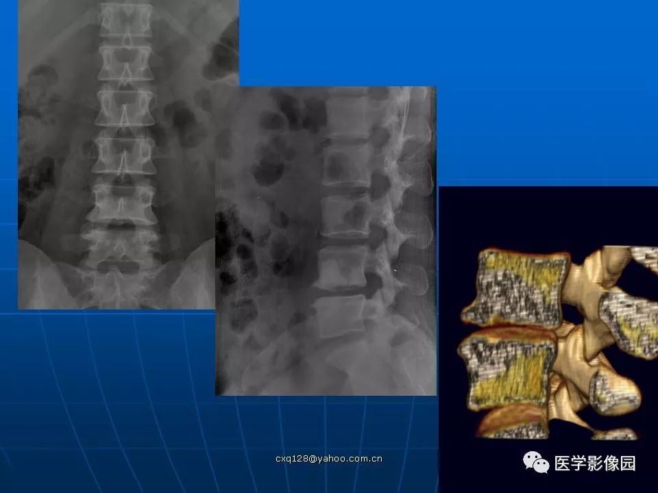 椎体终板骨软骨炎的影像学表现