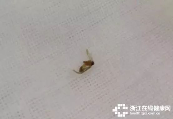 一觉醒来浙江女子感觉耳朵有东西医生竟从里面取出活的