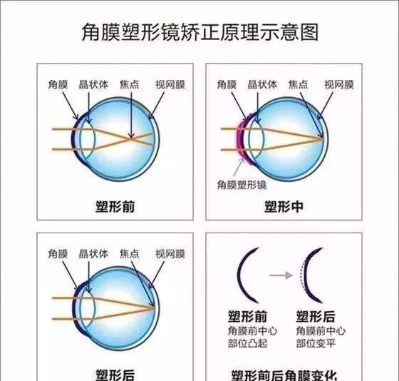 暑假来临,你的角膜塑形镜是不是也放假了?