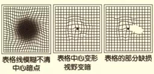 伪装成老花眼的致盲杀手,你知道是什么吗