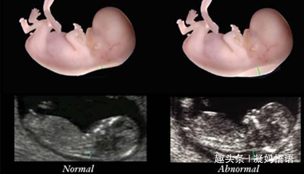 怀孕3个月,看懂B超单上这两个数据,胎儿就没有