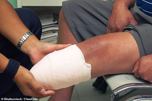 为了变成残疾人,他用冰冻坏自己大腿,再用石头砸烂.