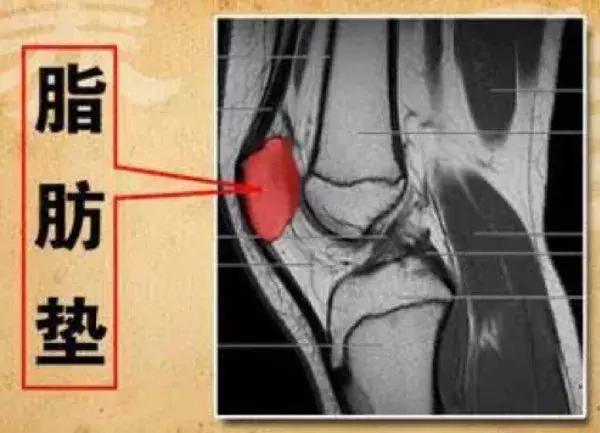 研究发现,髌下脂肪垫炎是膝关节退行性改变的早期临床表现,在引发膝