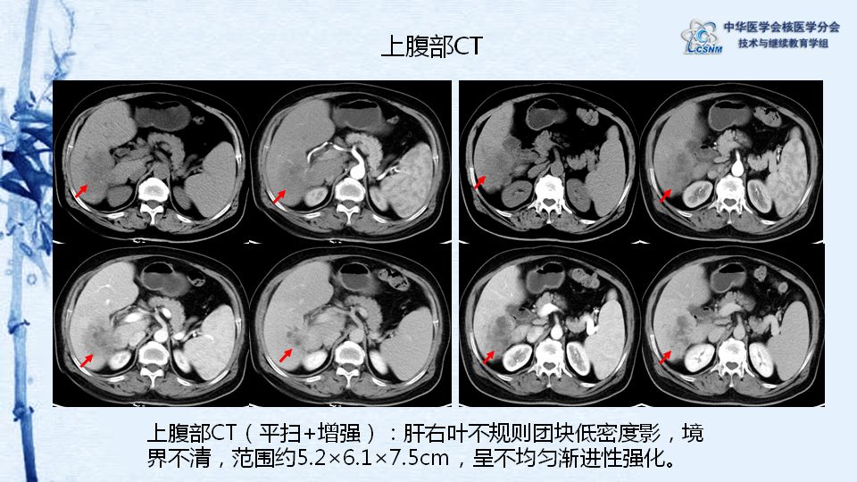 【病例】46期:黄谋清 | 肝占位pet-ct显像一例