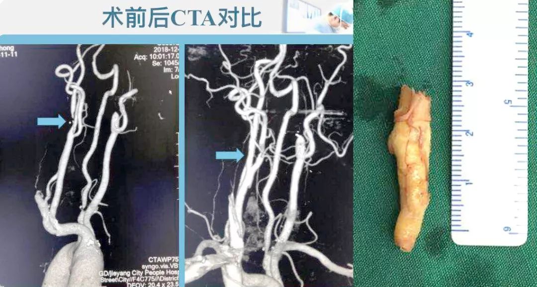 我院神经介入外科提醒市民:关注颈动脉斑块 警惕"隐形杀手"!