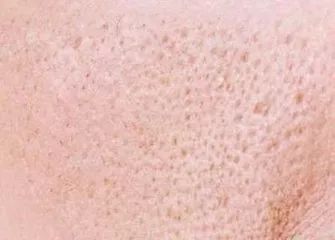 怎样才能不长痘痘闭口 f079e8e8cc794687a919460f76a6a956.jpeg