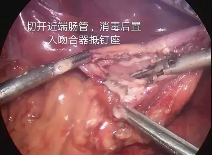 普外二科腹部无刀口能做直肠癌吗