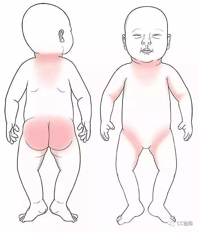                     强生爽身粉致癌案再输诉讼，被判314亿天价赔偿，你还要坚持给娃用痱子粉吗？?
