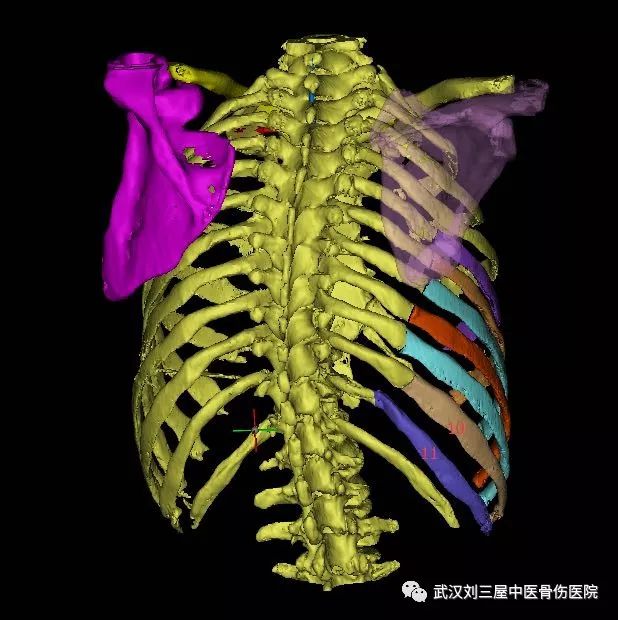 及3d打印技术充分了解多发肋骨骨折的立体解剖结构,利用三维重建,术前