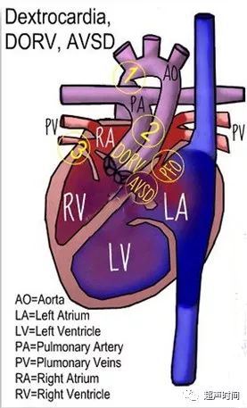 示意图示右旋心,右室双出口和部分型房室共道 病例 2:患者孕 24 周