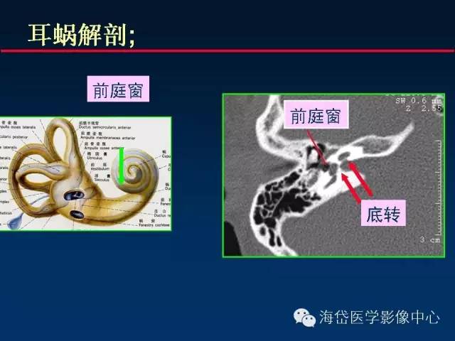 颅底重要ct解剖及其临床意义前庭导水管与耳蜗