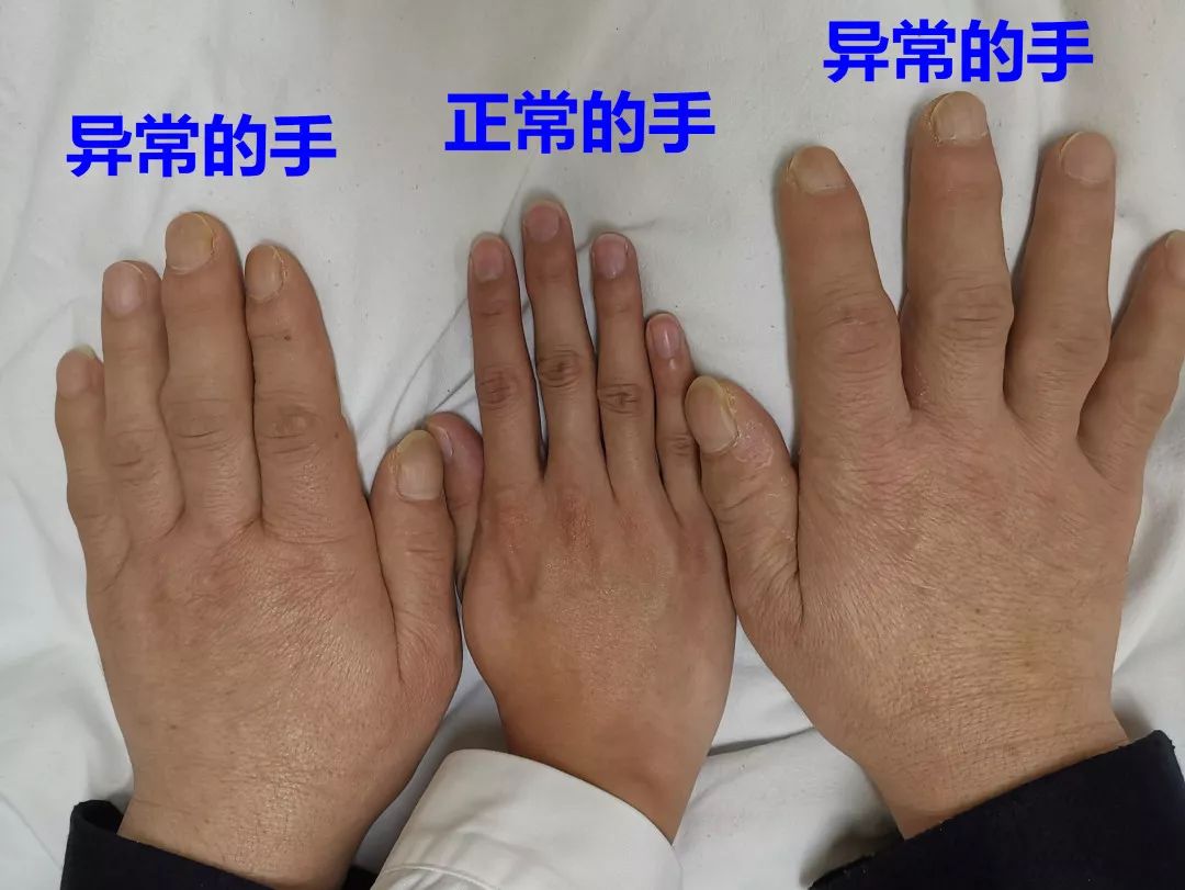 正常人的手与肢端肥大症患者的手作对比