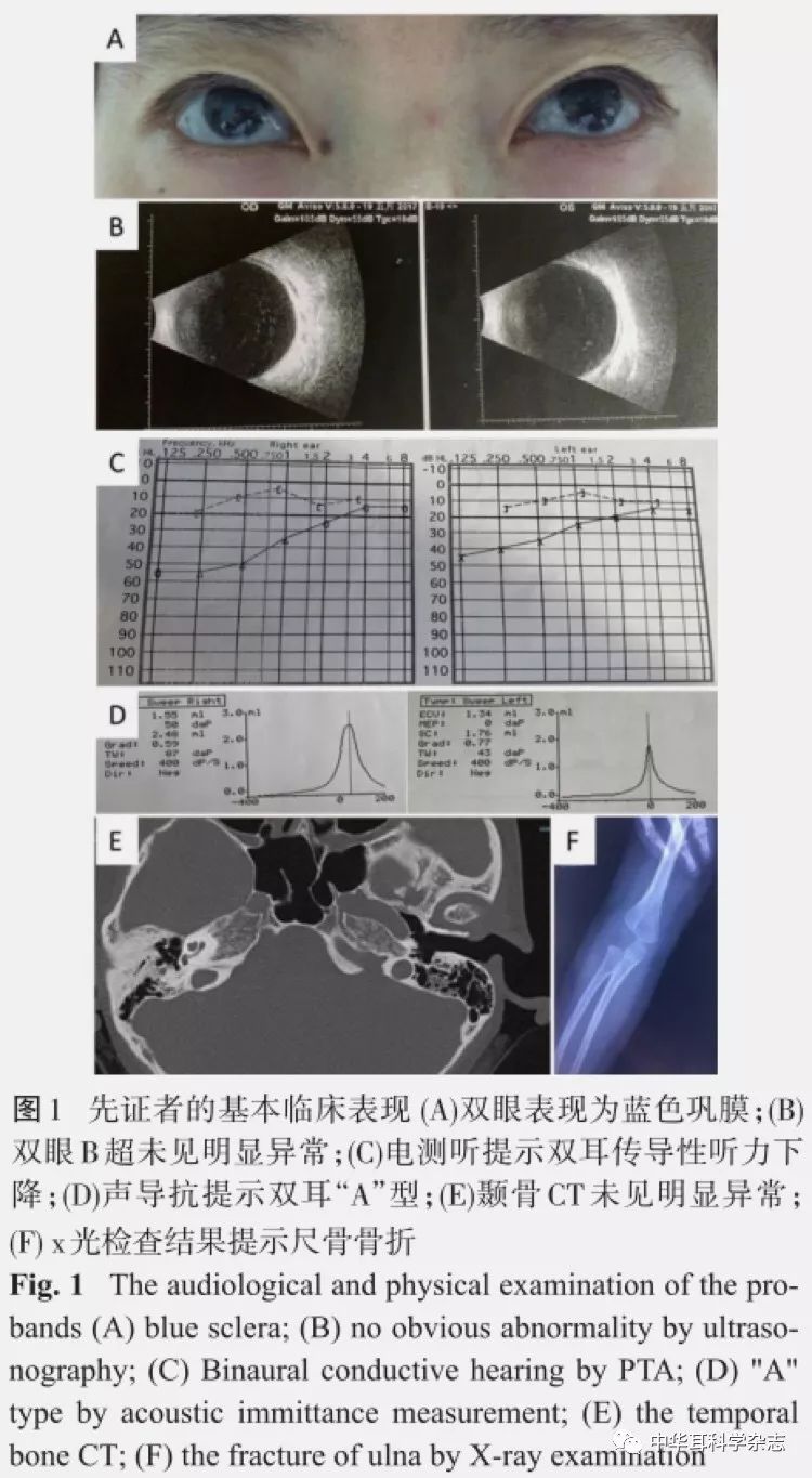 鼓膜完整,音叉rinne试验256,512 hz均为阴性,weber试验偏向耳聋较重侧