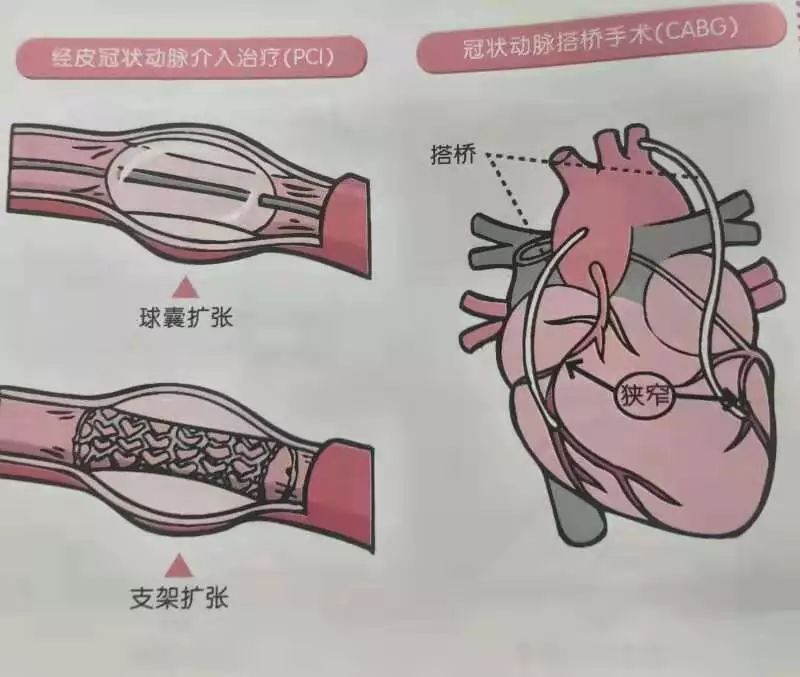 血管儿的手术治疗是指经皮冠状动脉介入治疗和冠状动脉搭桥手术.