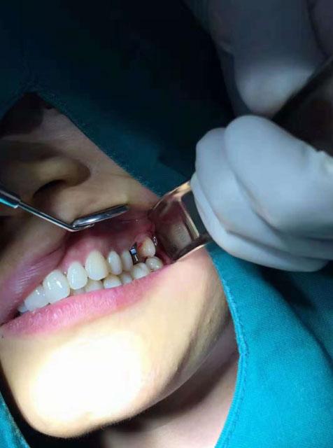 举个真实案例,有位病人非常想即刻种牙,但拍完 x 光片,医生清楚的