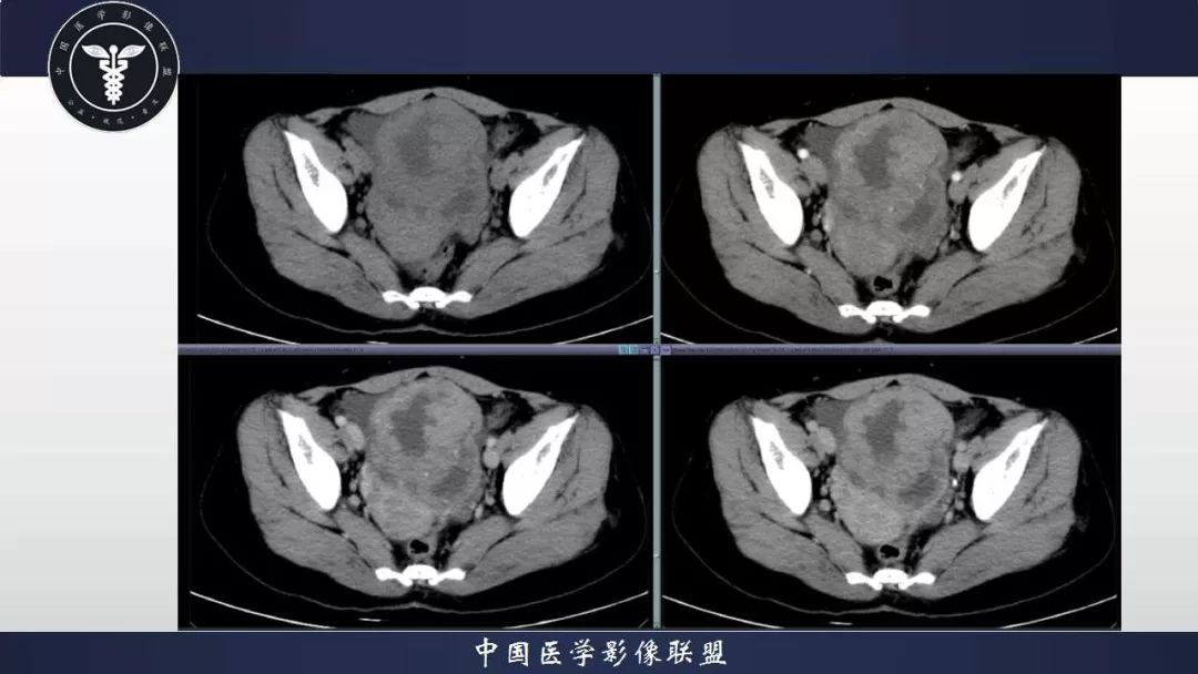 颗粒细胞瘤与子宫内膜样癌鉴别.